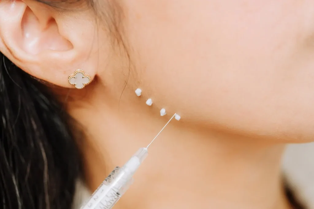 jawline of a woman with small dots of product and an injection needle