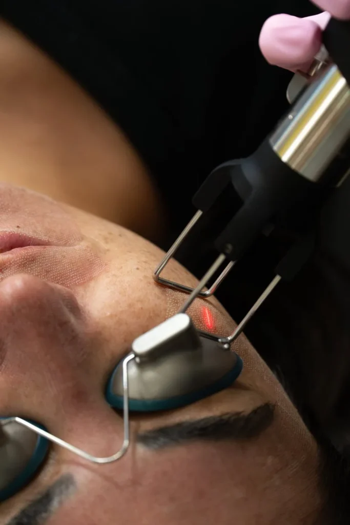 coolpeel laser wedding skin prep