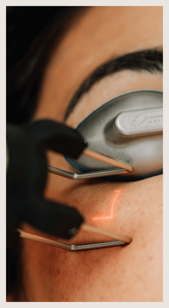 DEKA CO2 laser