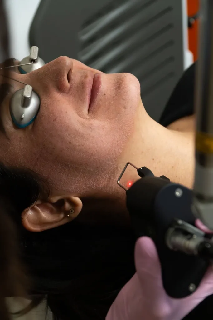 closeup of a woman receiving a coolpeel treatment