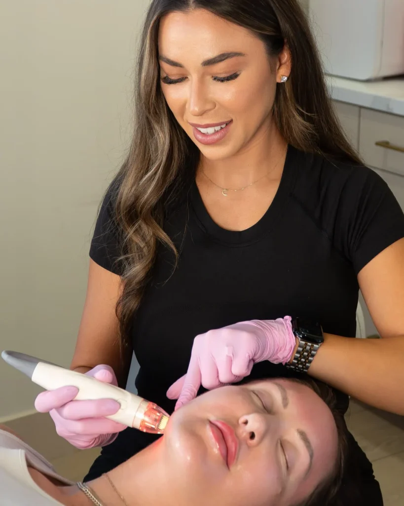woman receiving vivace rf microneedling on the jaw area
