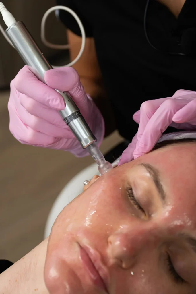 closeup of a women receiving microneedling as part of melasma treatment