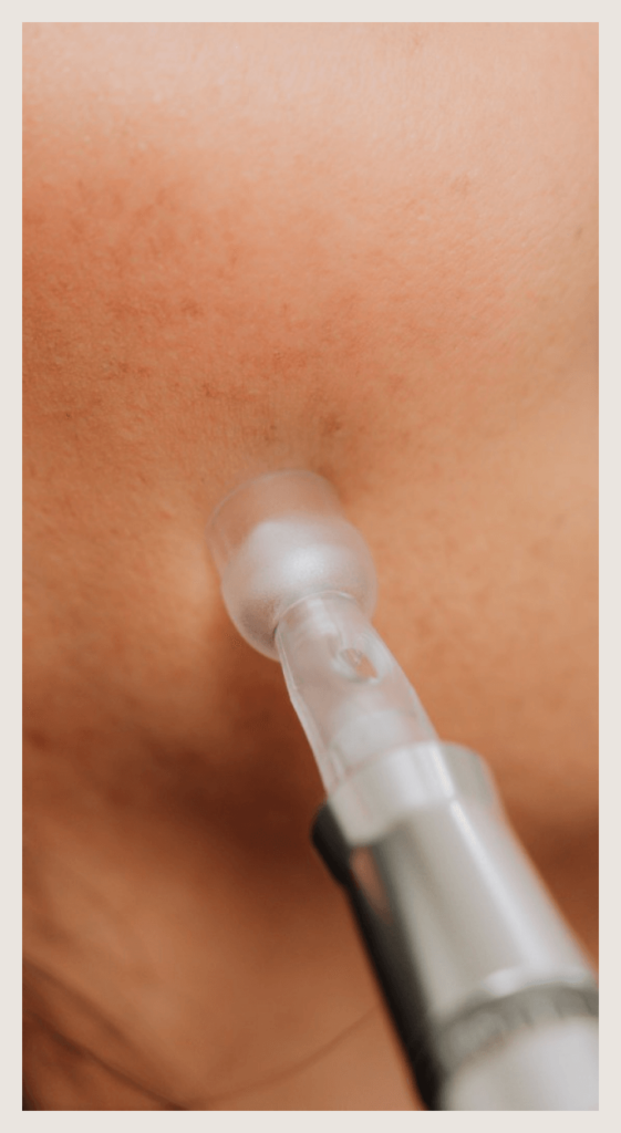 closeup of microneedling in the cheek
