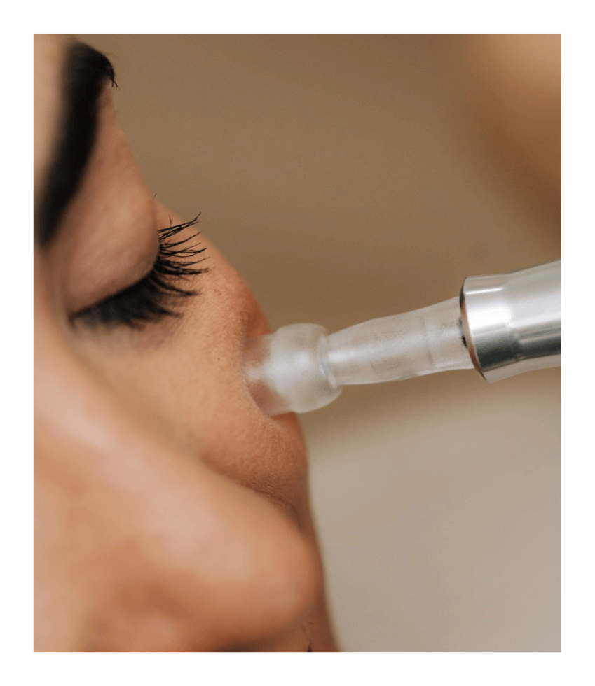 closeup of client receiving microneedling in the cheek at Curated Medical in Scottsdale