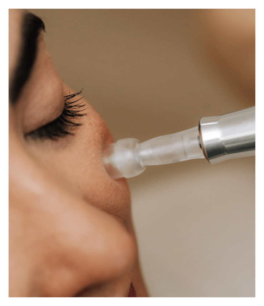 closeup of client receiving microneedling in the cheek at Curated Medical in Scottsdale