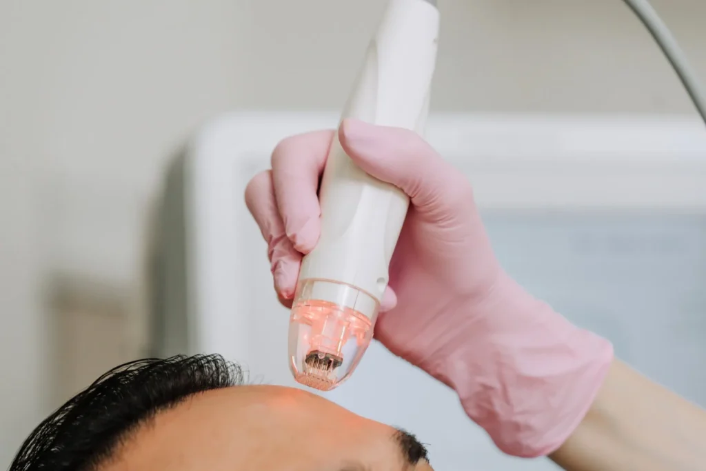 closeup of client receiving vivace rf microneedling on the forehead to treat skin laxity
