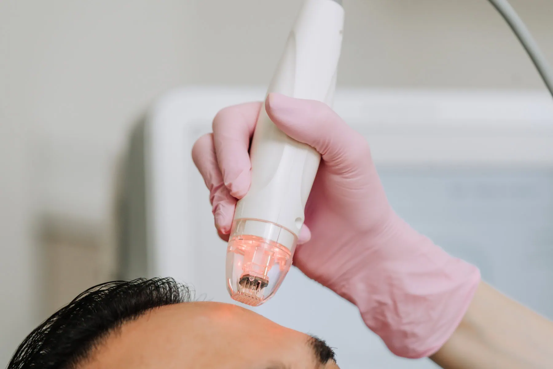 closeup of client receiving vivace rf microneedling on the forehead to treat skin laxity