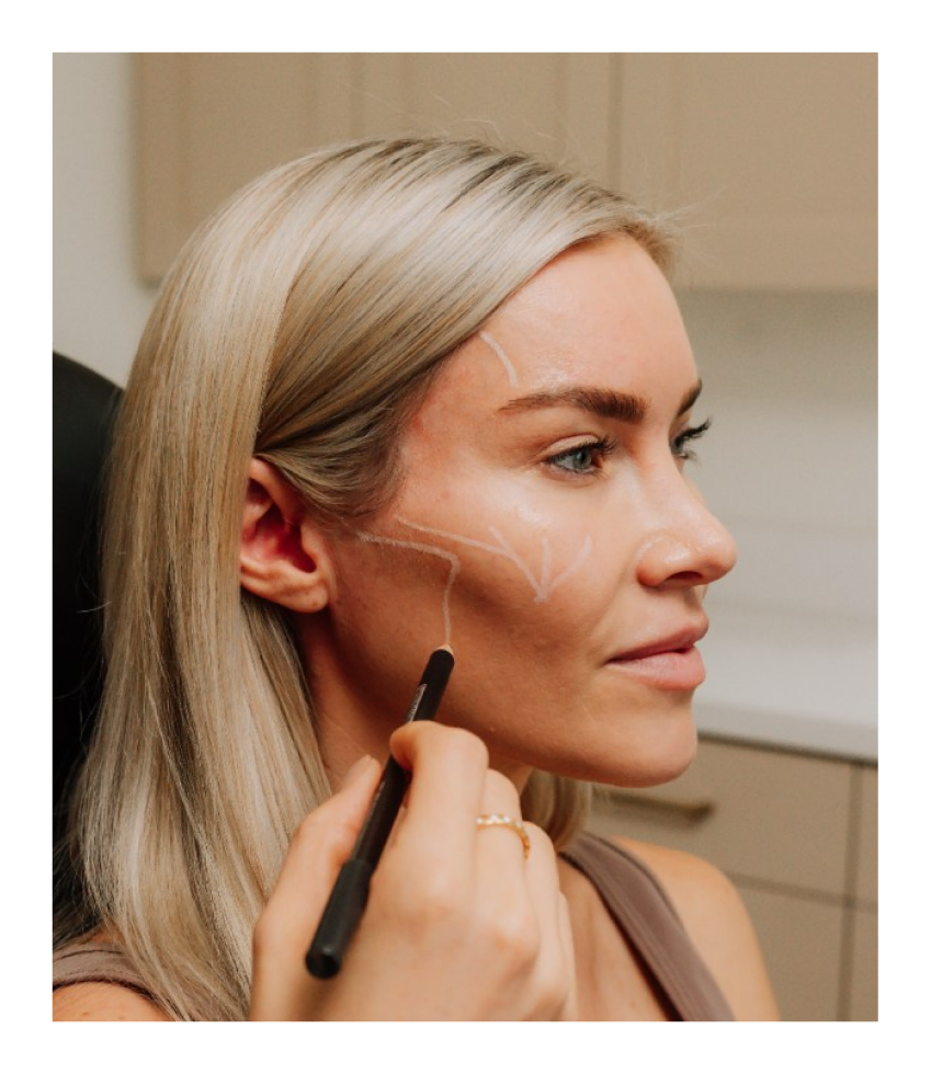 close-up of a woman receiving a sculptra injection in her right cheek at Curated Medical in Scottsdale
