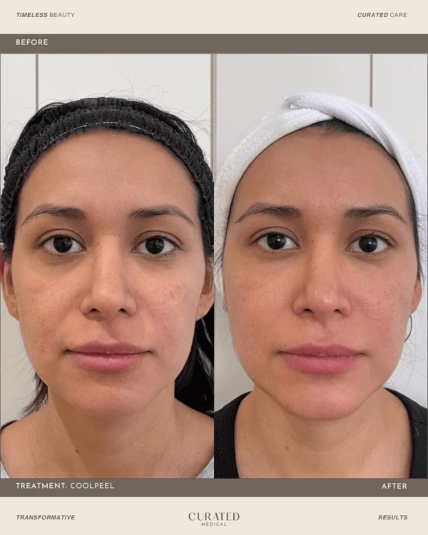 client before and after co2 laser resurfacing