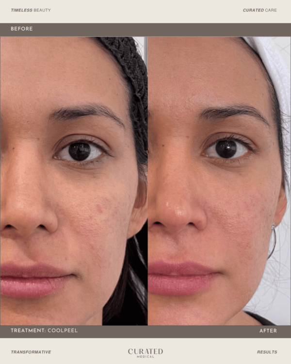 client before and after co2 laser resurfacing