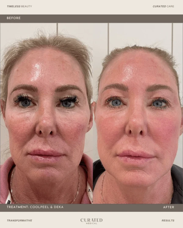 client before and after co2 laser resurfacing