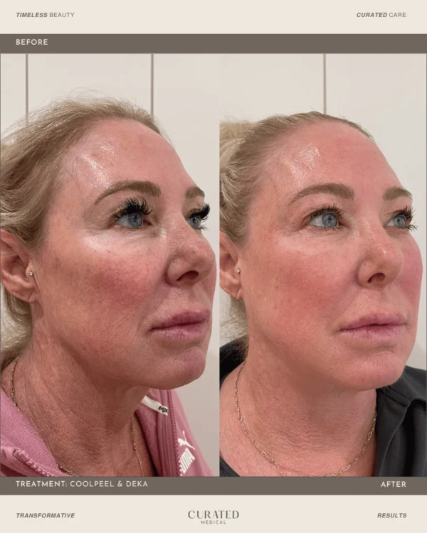 client before and after co2 laser resurfacing