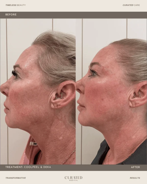 client before and after co2 laser resurfacing