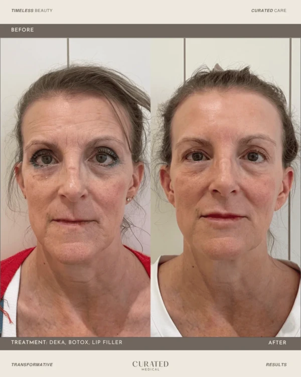 client before and after co2 laser resurfacing with deka