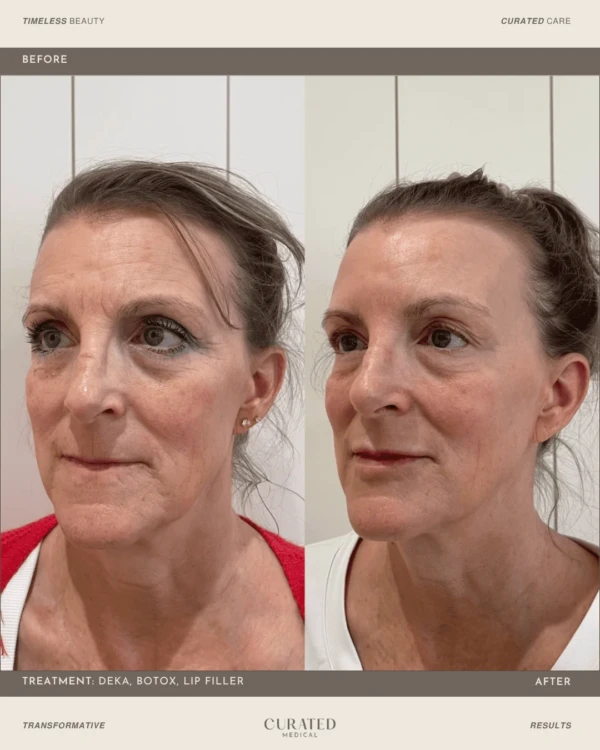 client before and after co2 laser resurfacing with deka